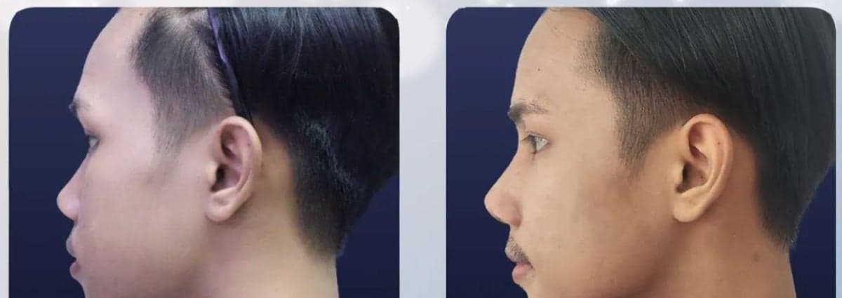 tip rhinoplasty