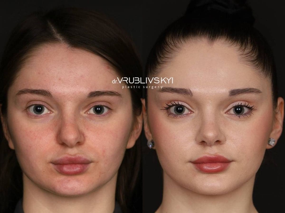 rhinoplasty