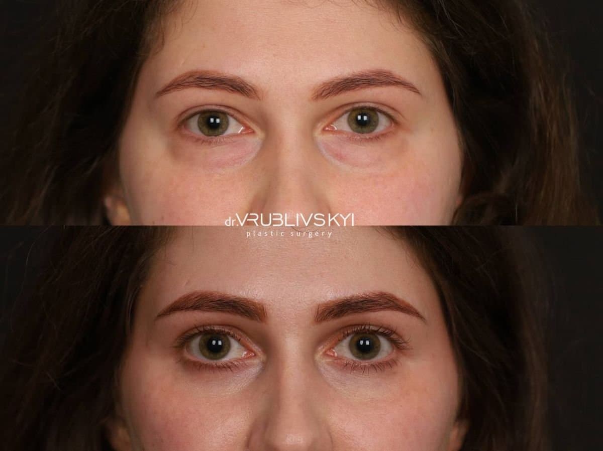blepharoplasty