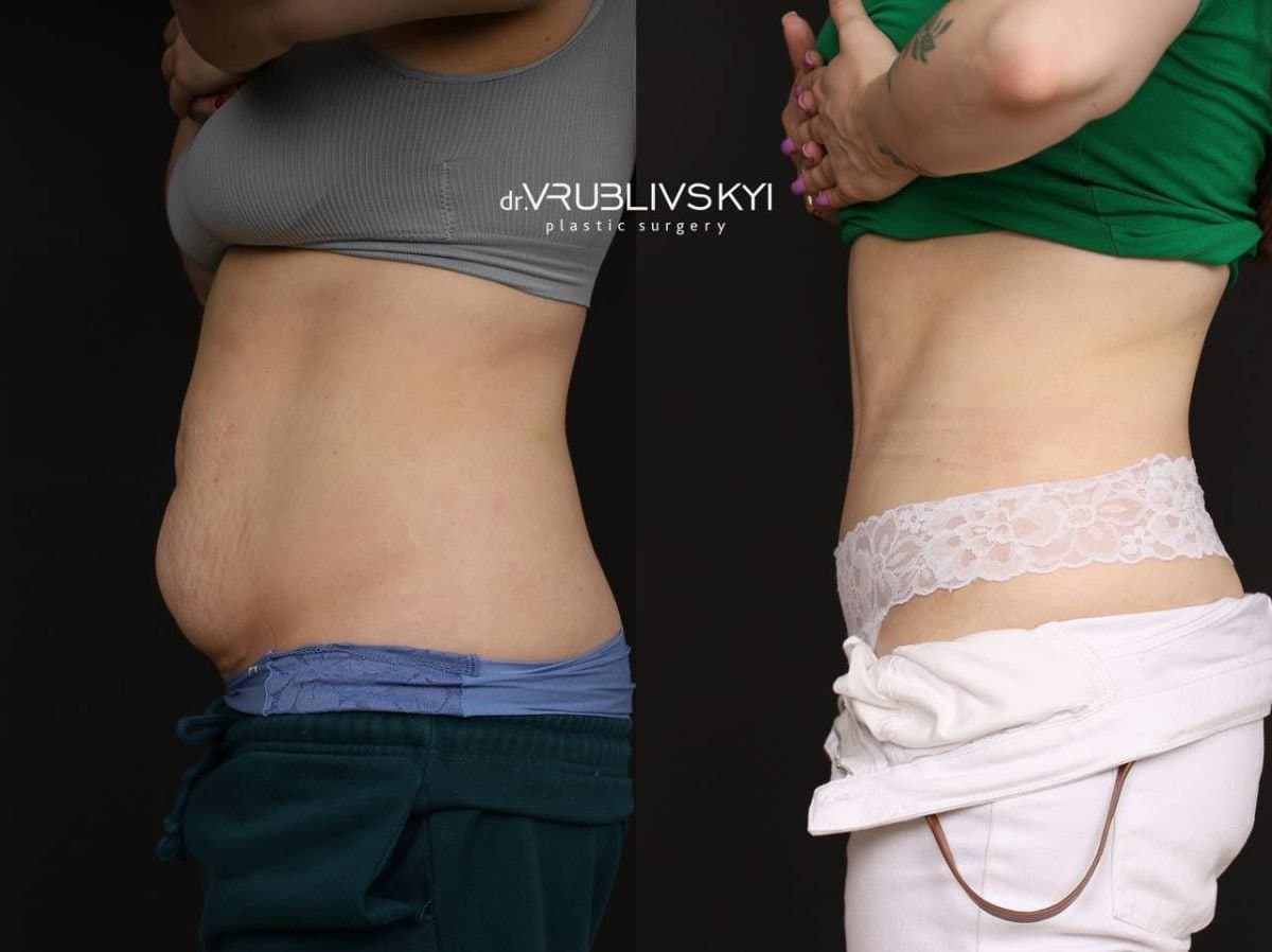 liposuction