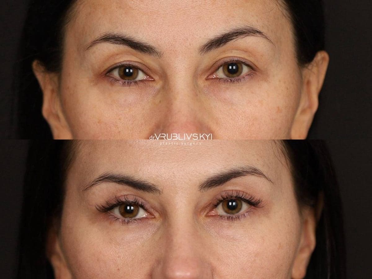 blepharoplasty