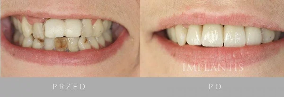 dental implant