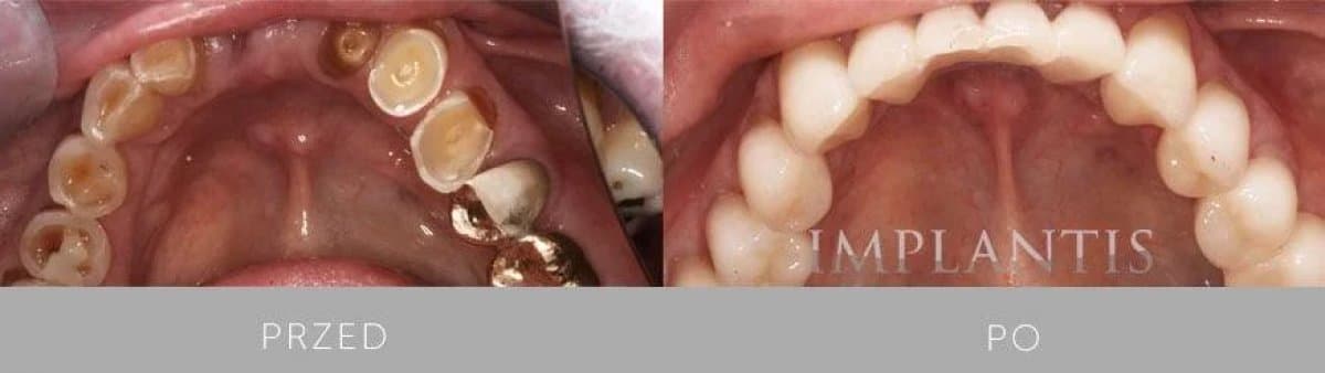 Hollywood Smile