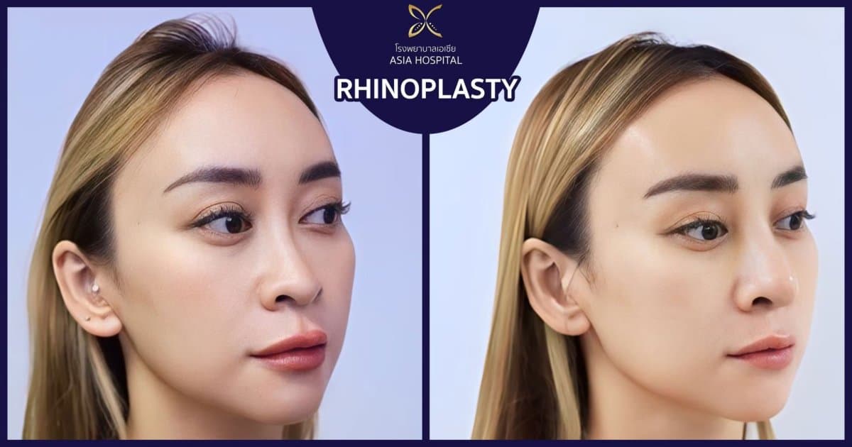 rhinoplasty