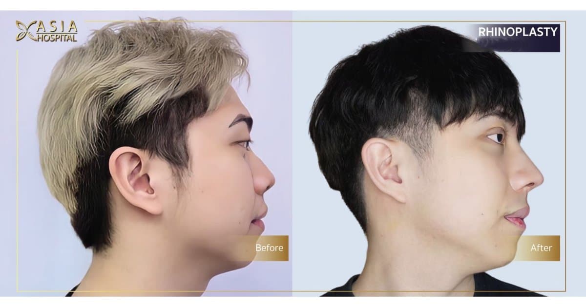 rhinoplasty