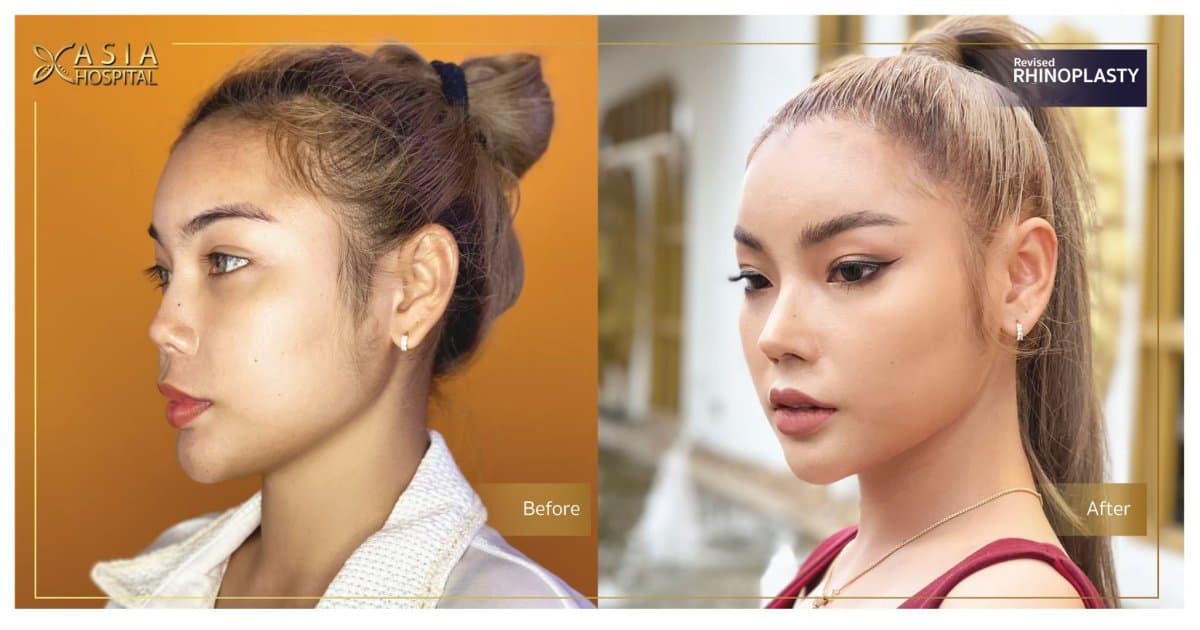 open rhinoplasty