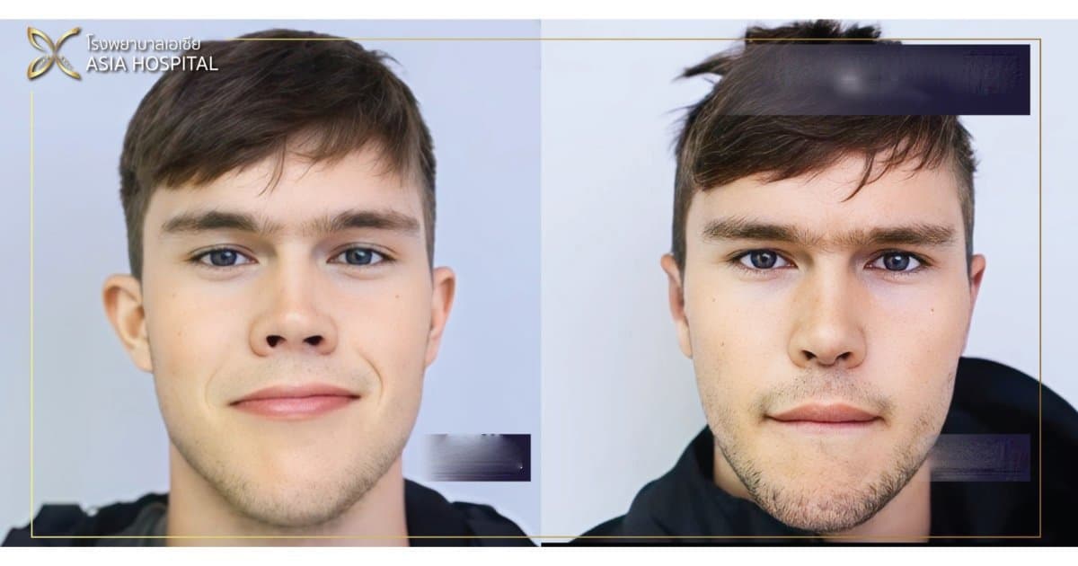 rhinoplasty