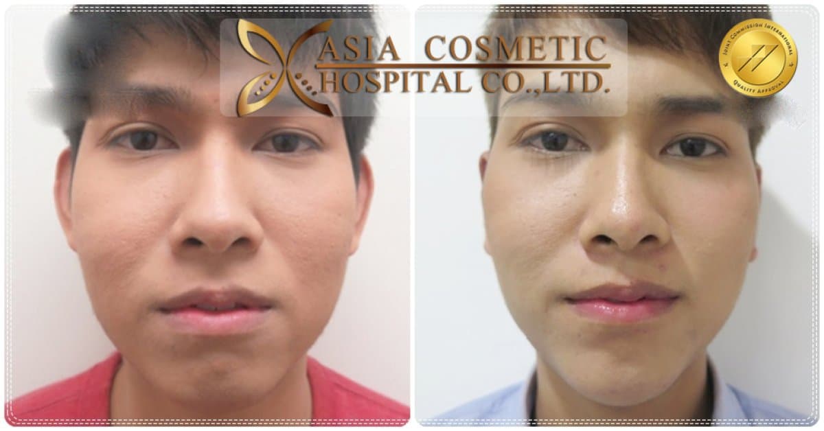 otoplasty
