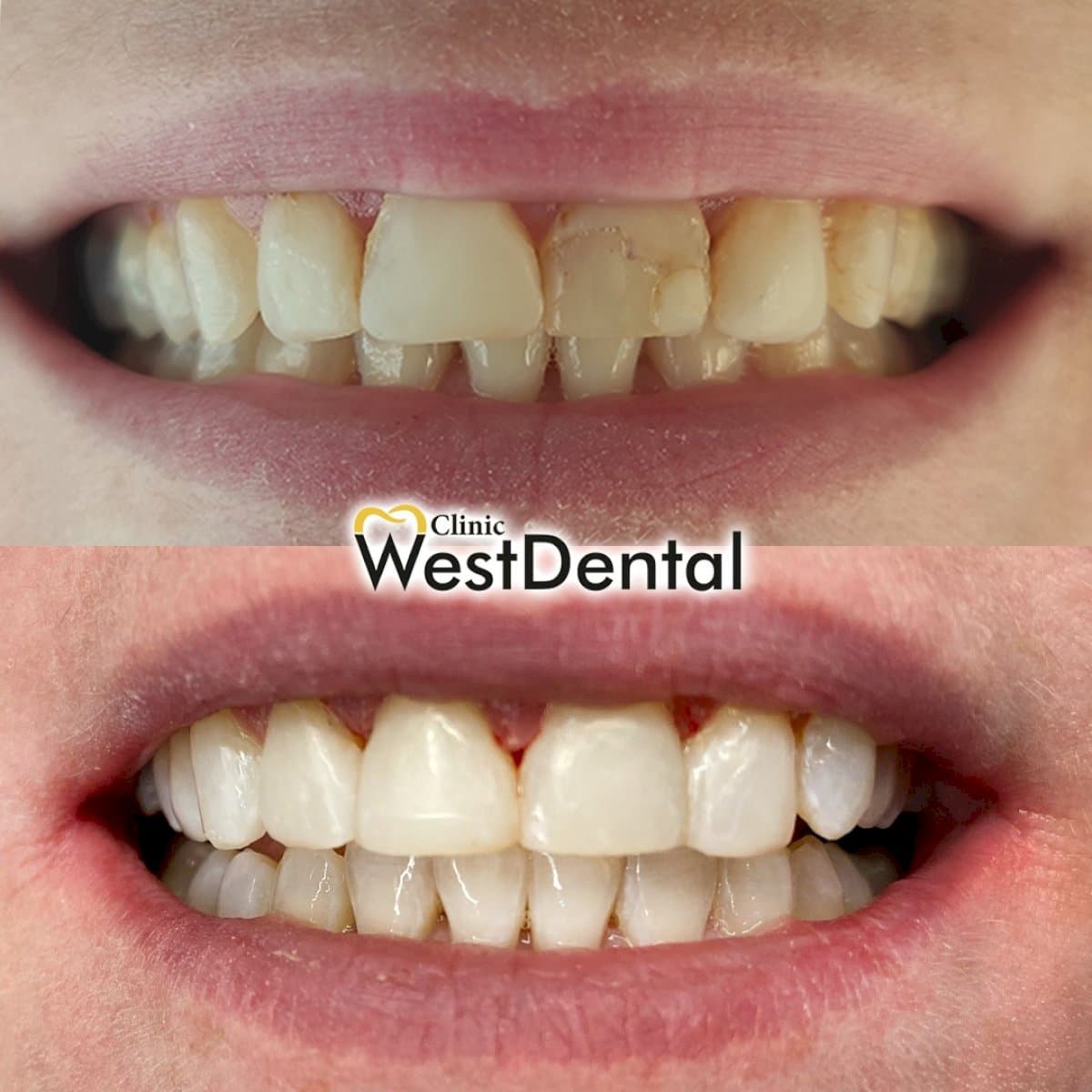 composite veneer