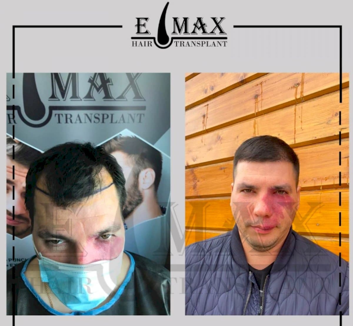 DHI hair transplant