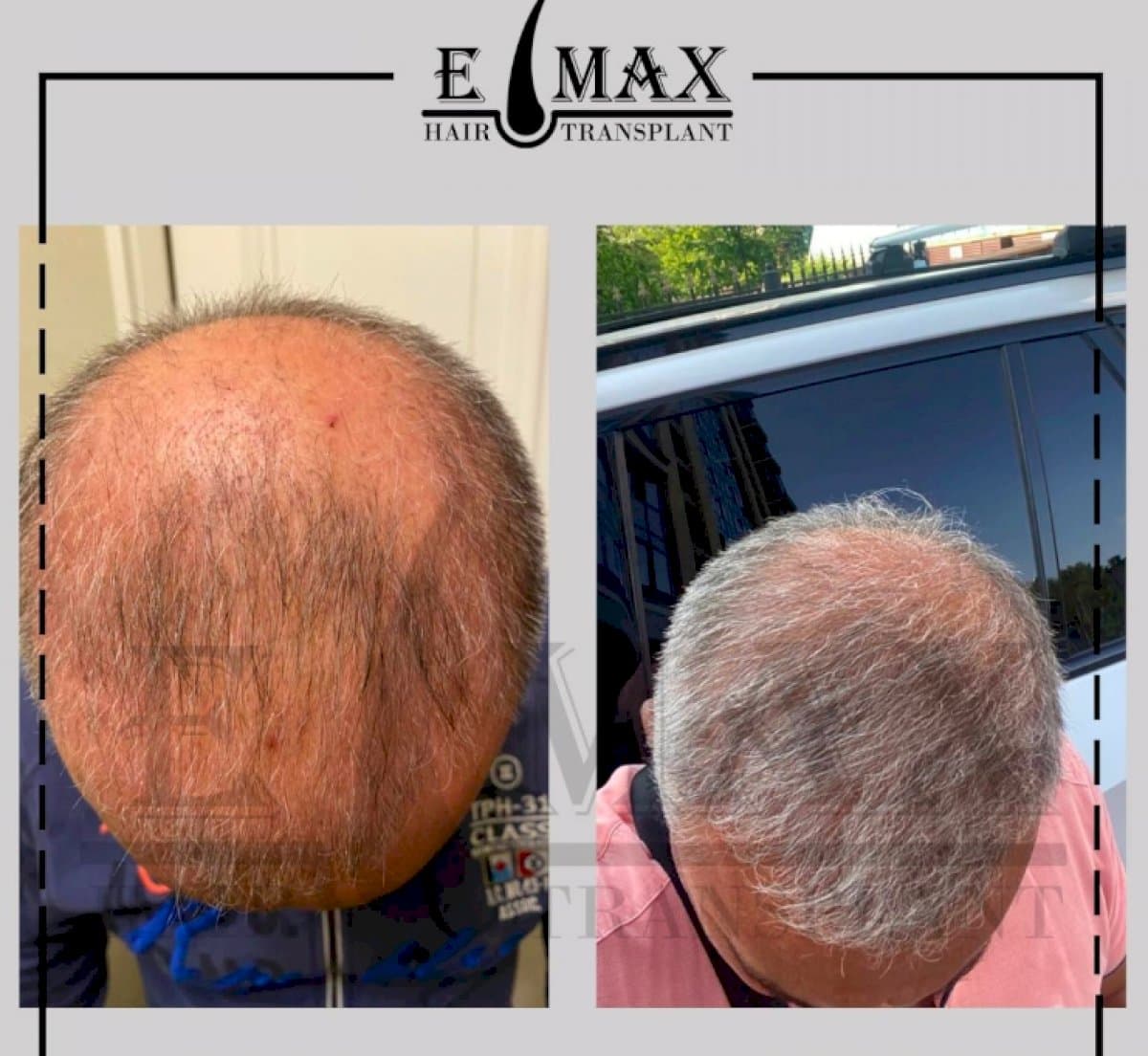 hair transplant