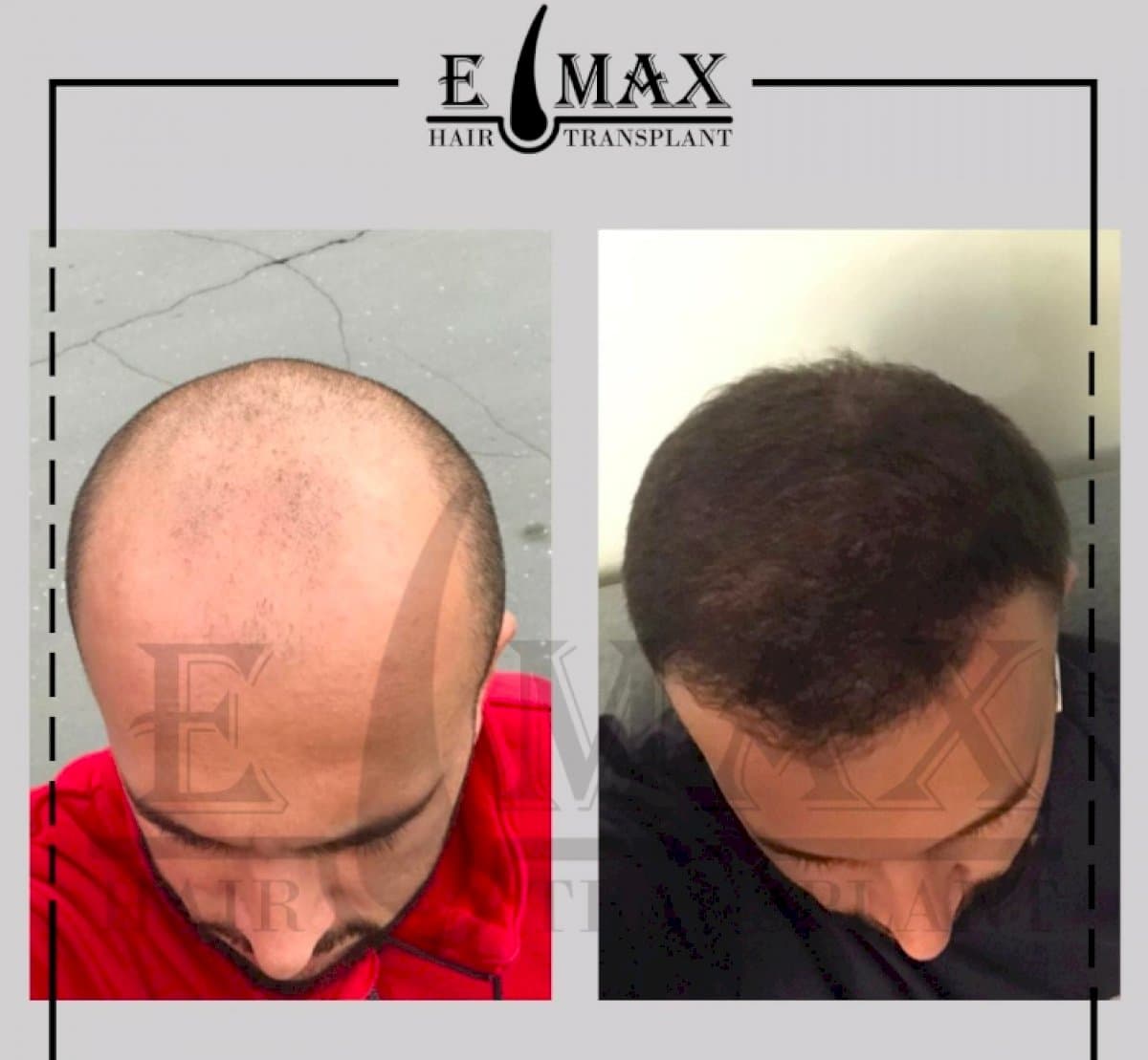 DHI hair transplant