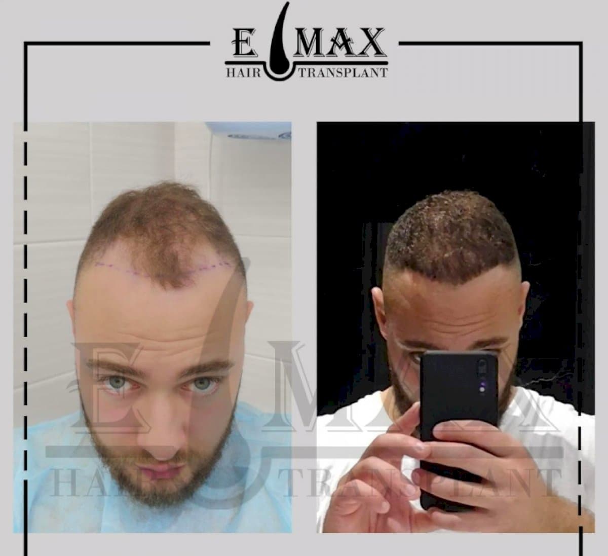 FUE hair transplant