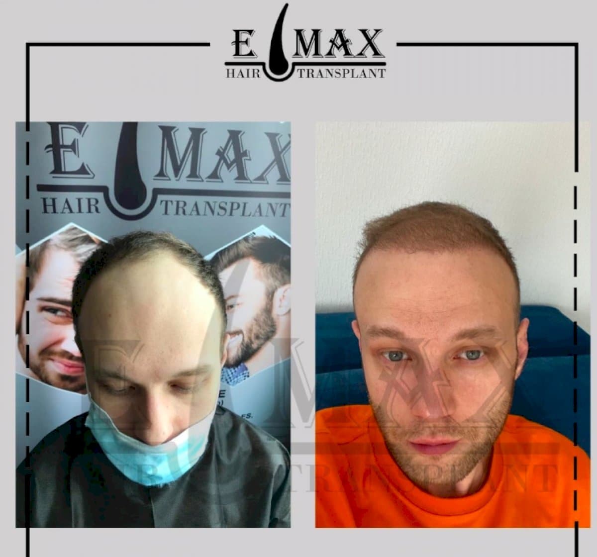 FUE hair transplant