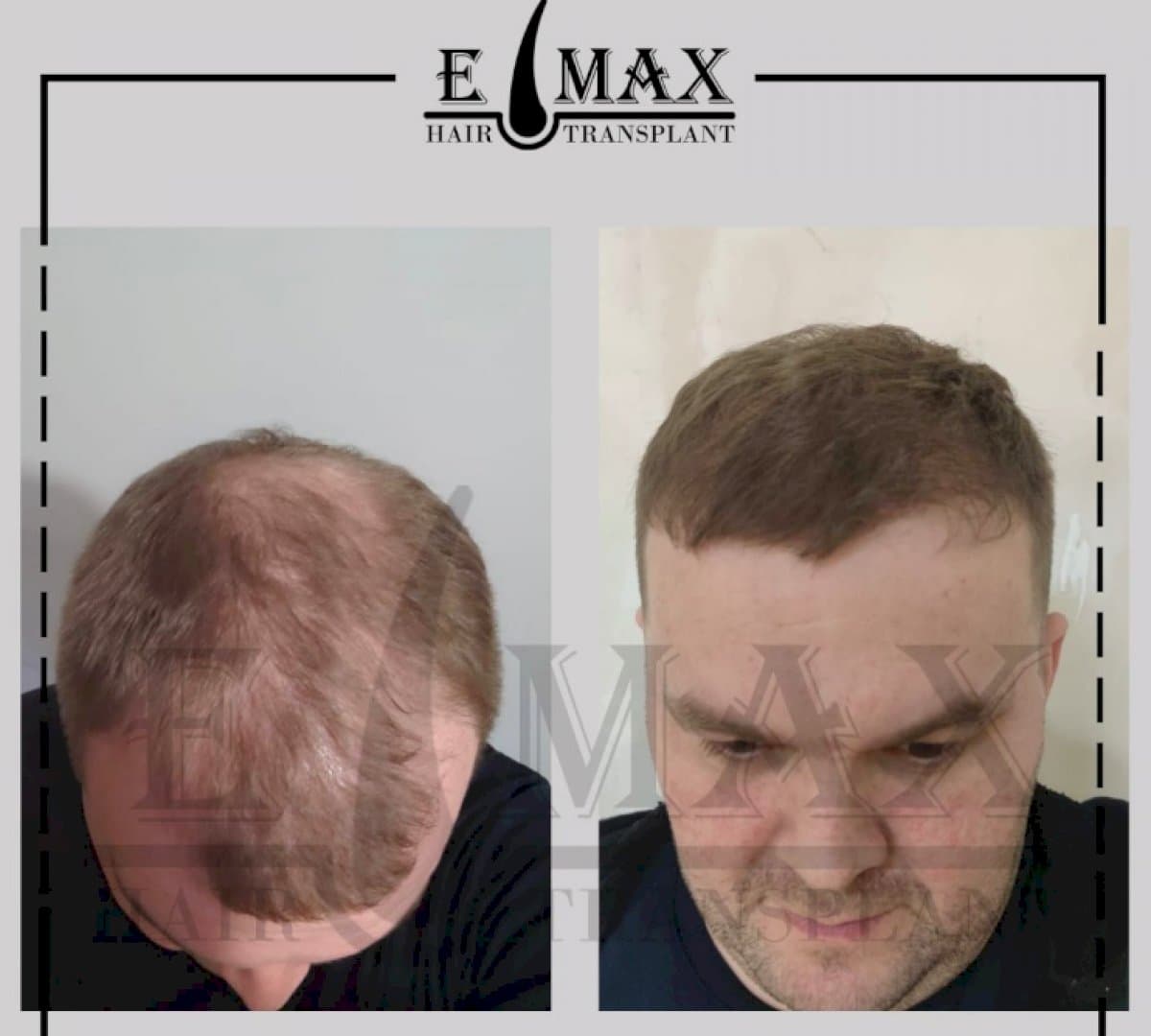 hair transplant