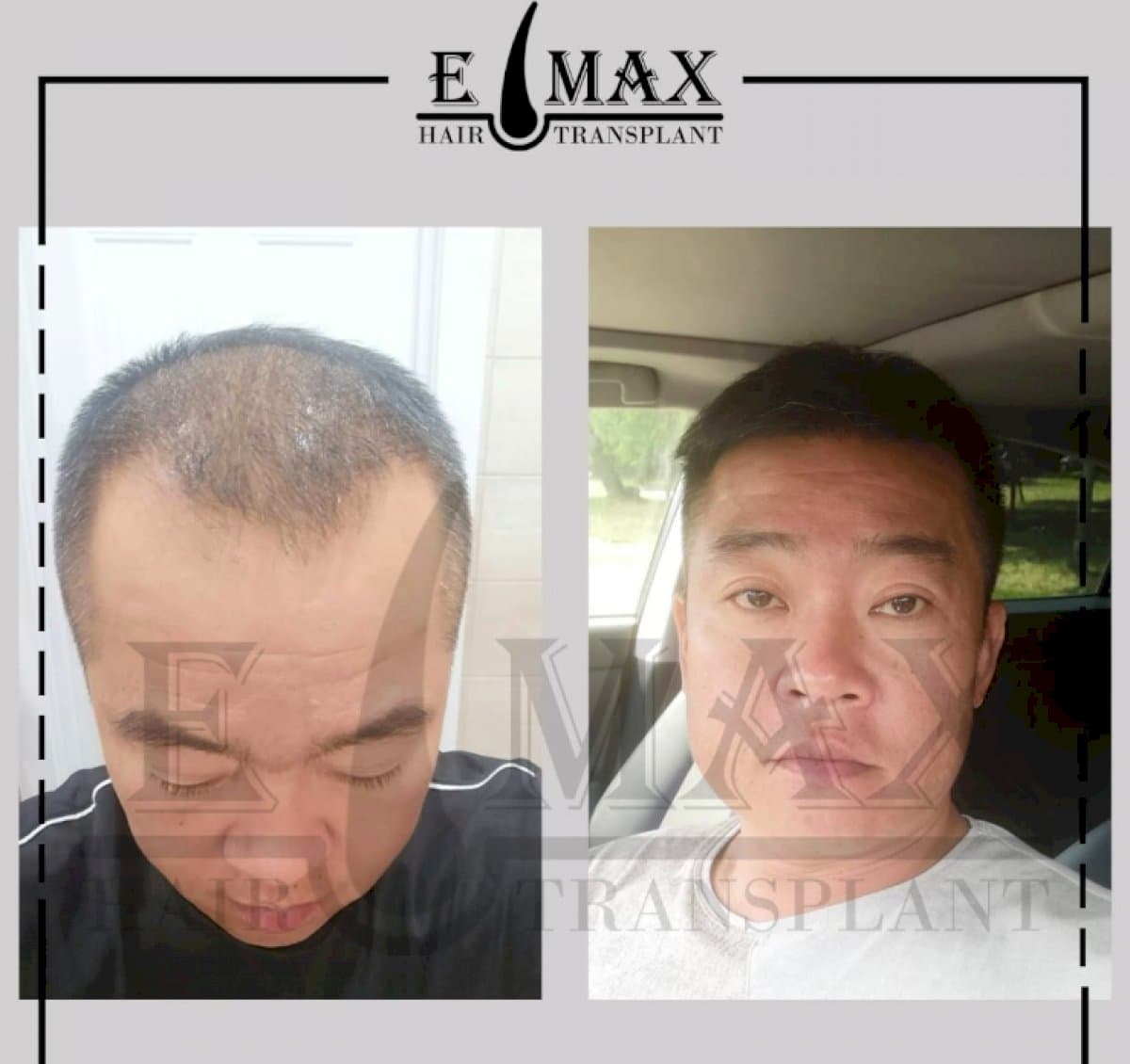 DHI hair transplant