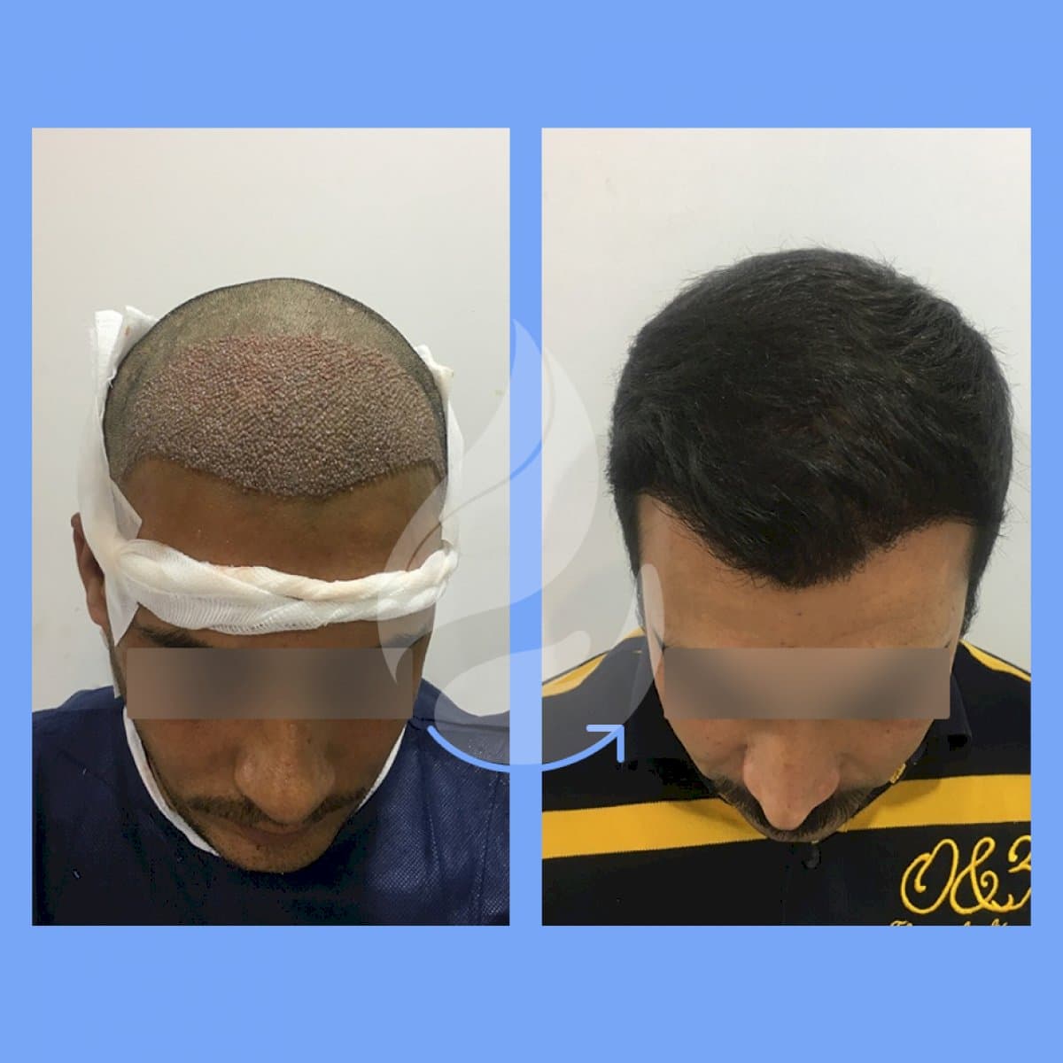 DHI hair transplant