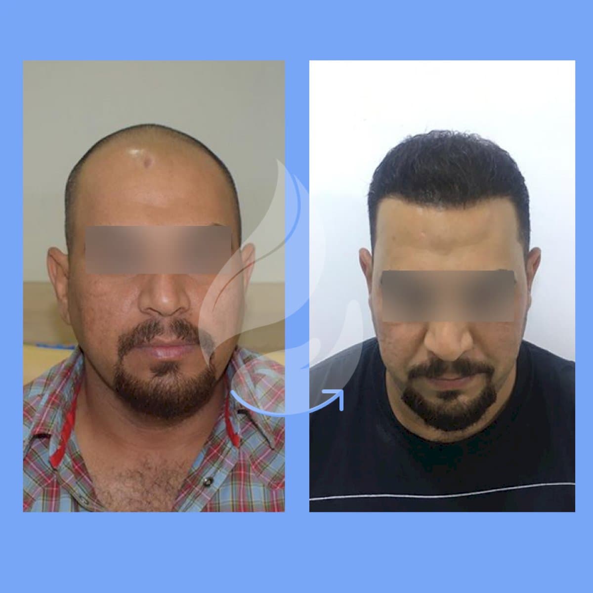 FUE hair transplant