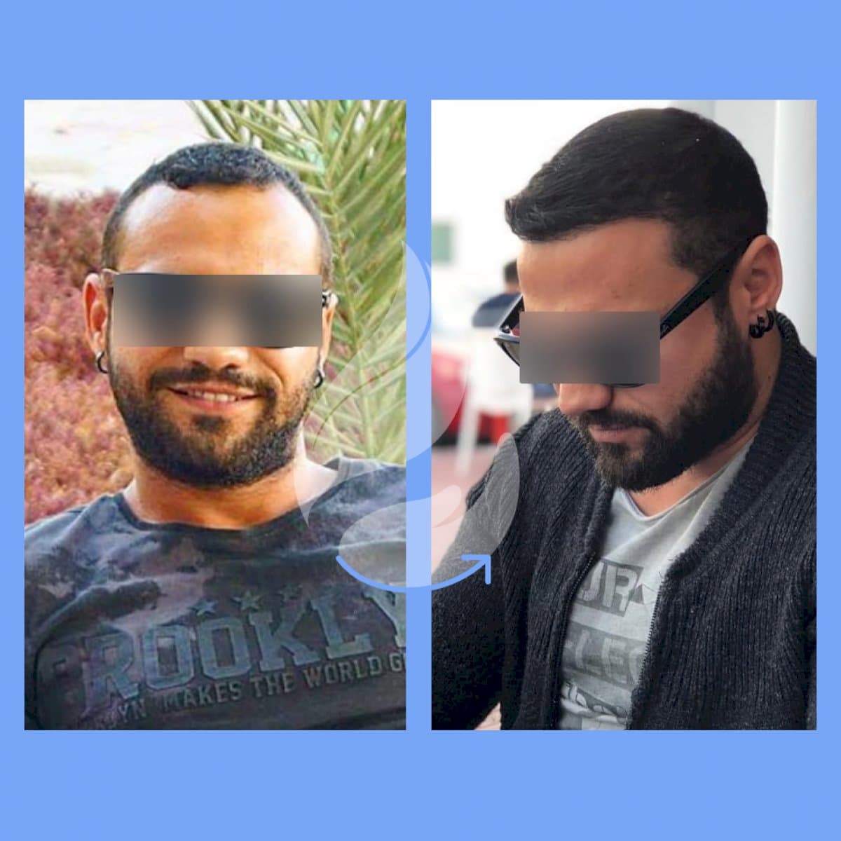 FUE hair transplant