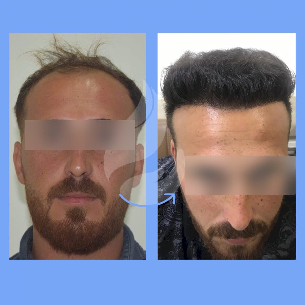 FUE hair transplant
