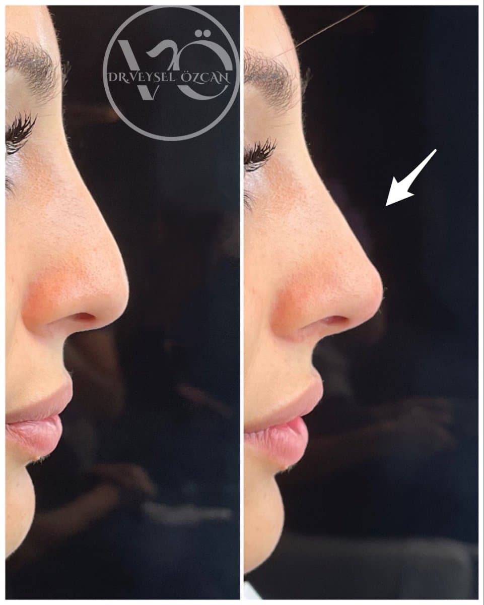 fillers injection