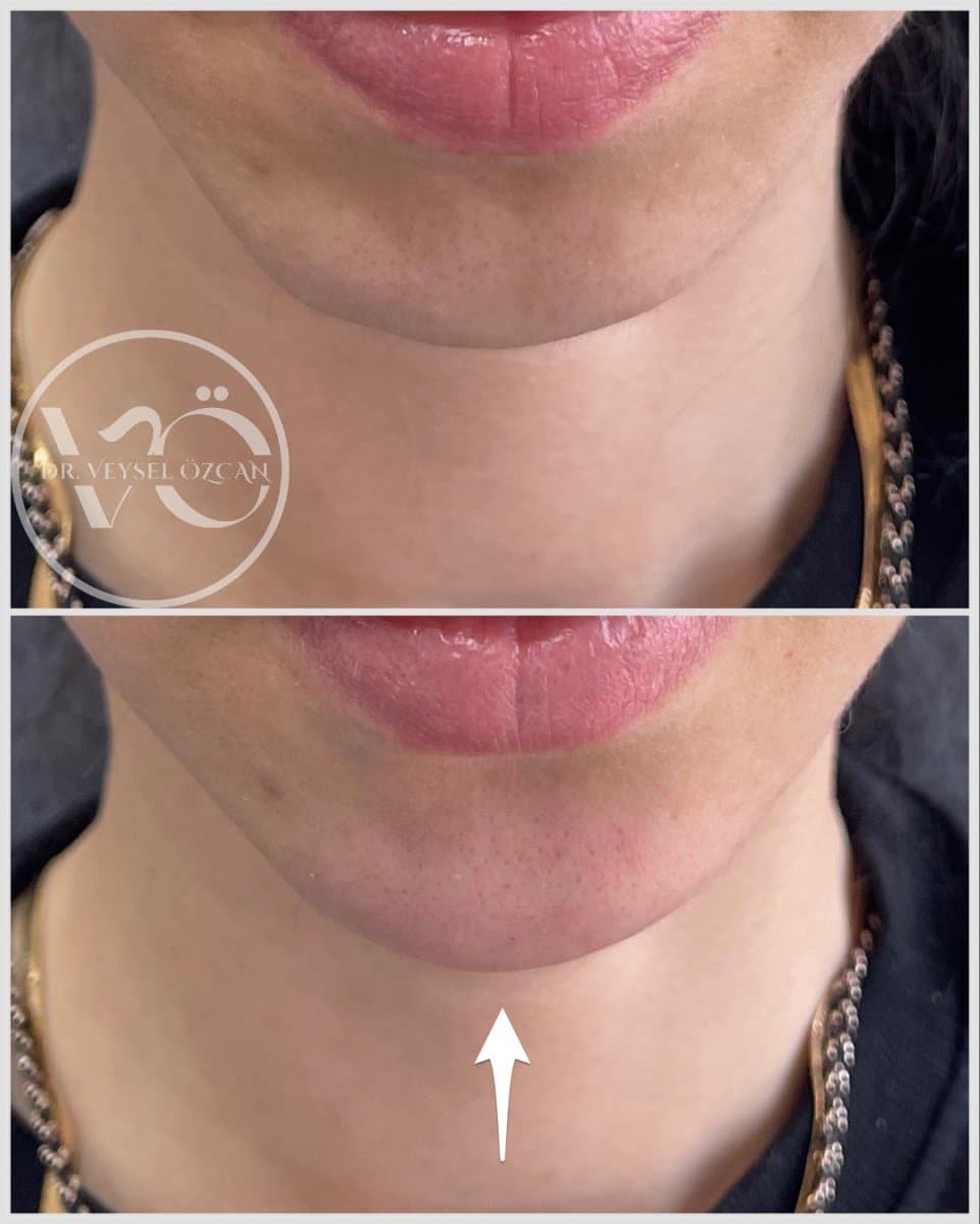 fillers injection