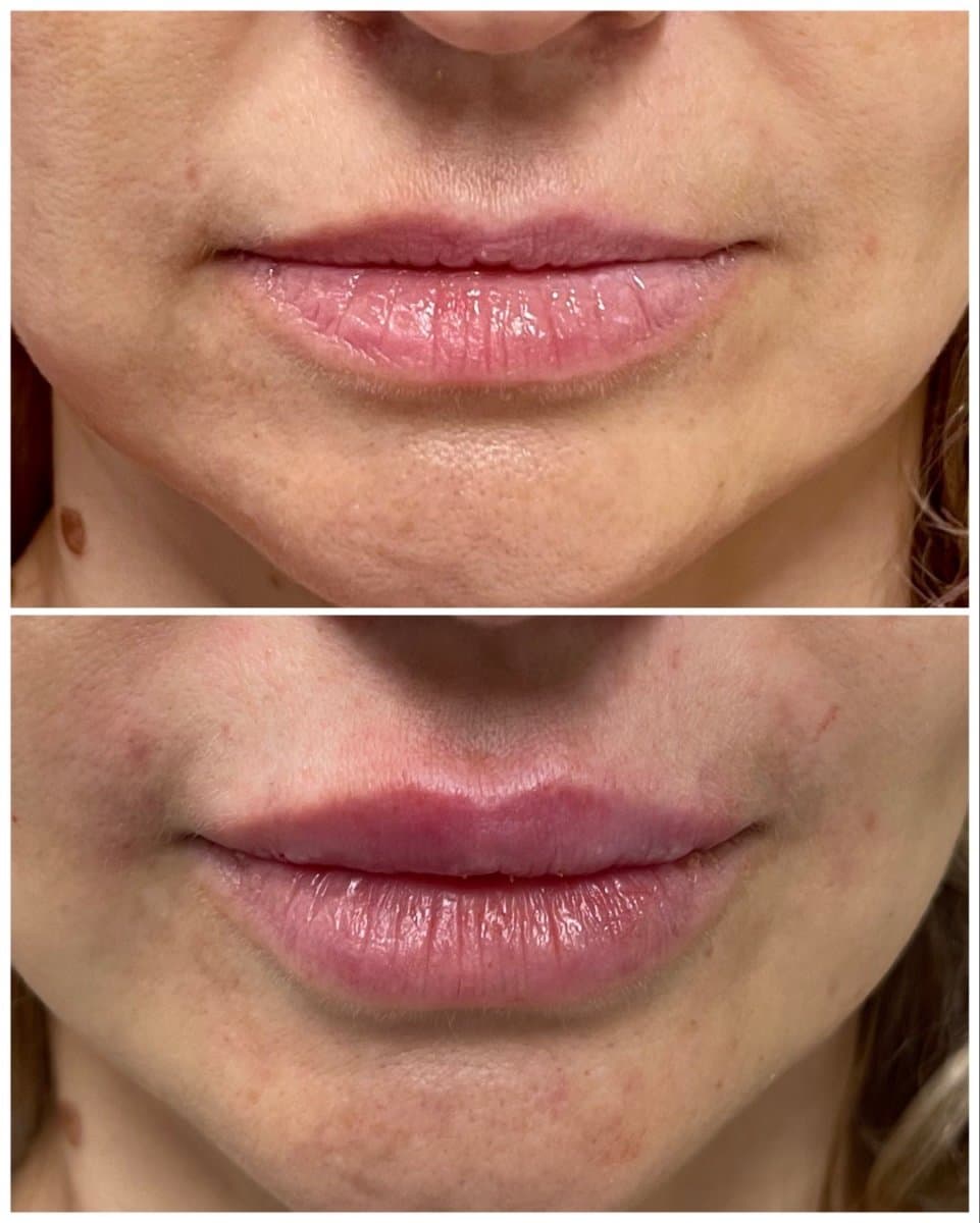 fillers injection