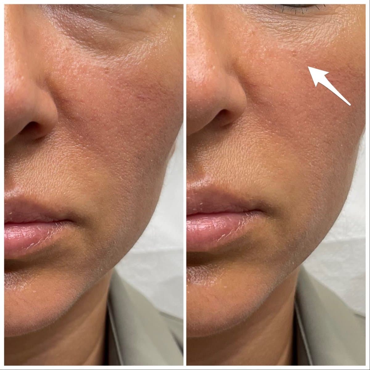 fillers injection