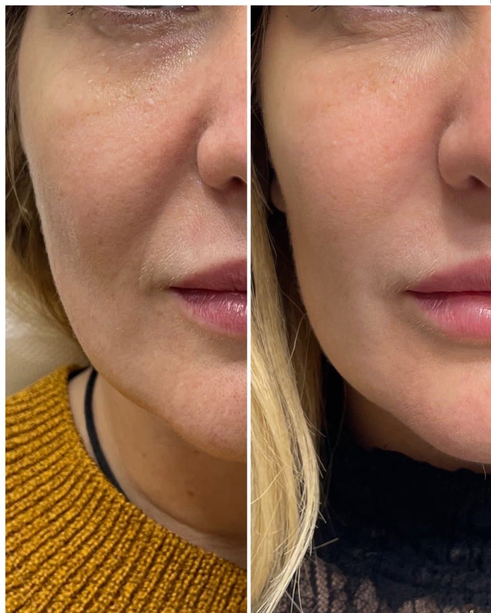 fillers injection