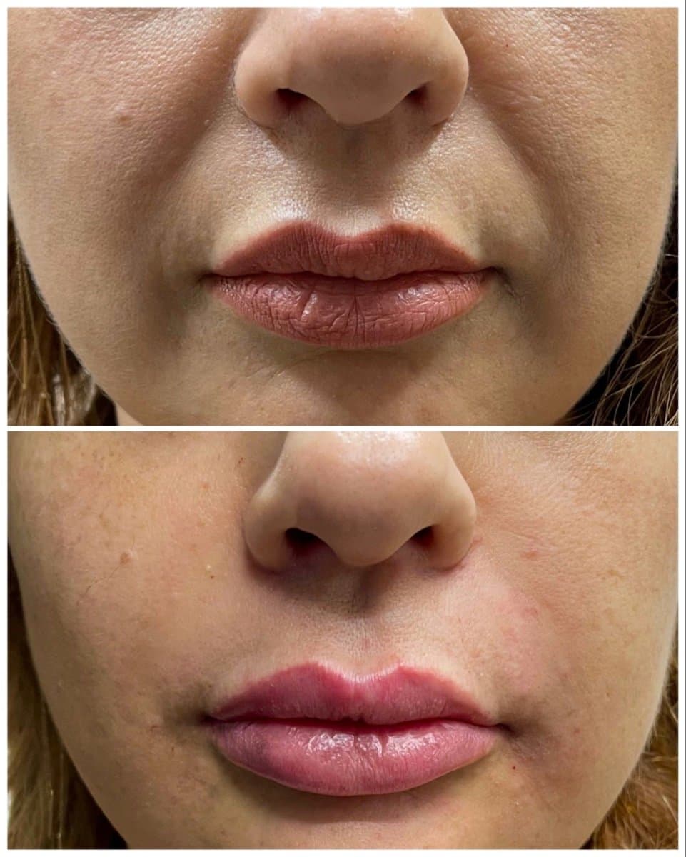 lip fillers injection