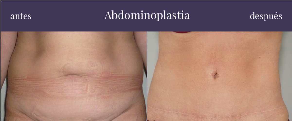 tummy tuck