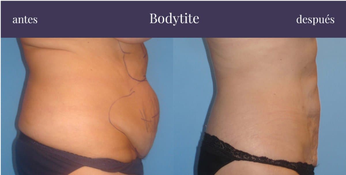 BodyTite