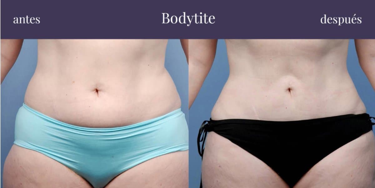 BodyTite