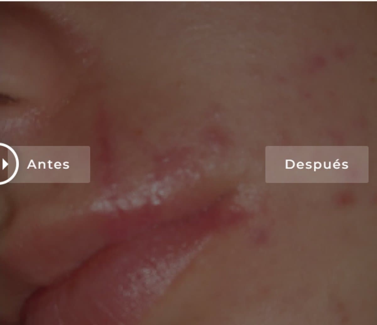 results on face
