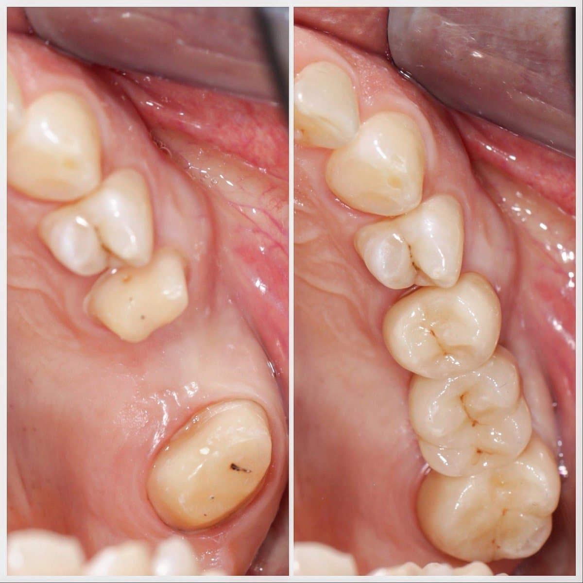 mini dental implant