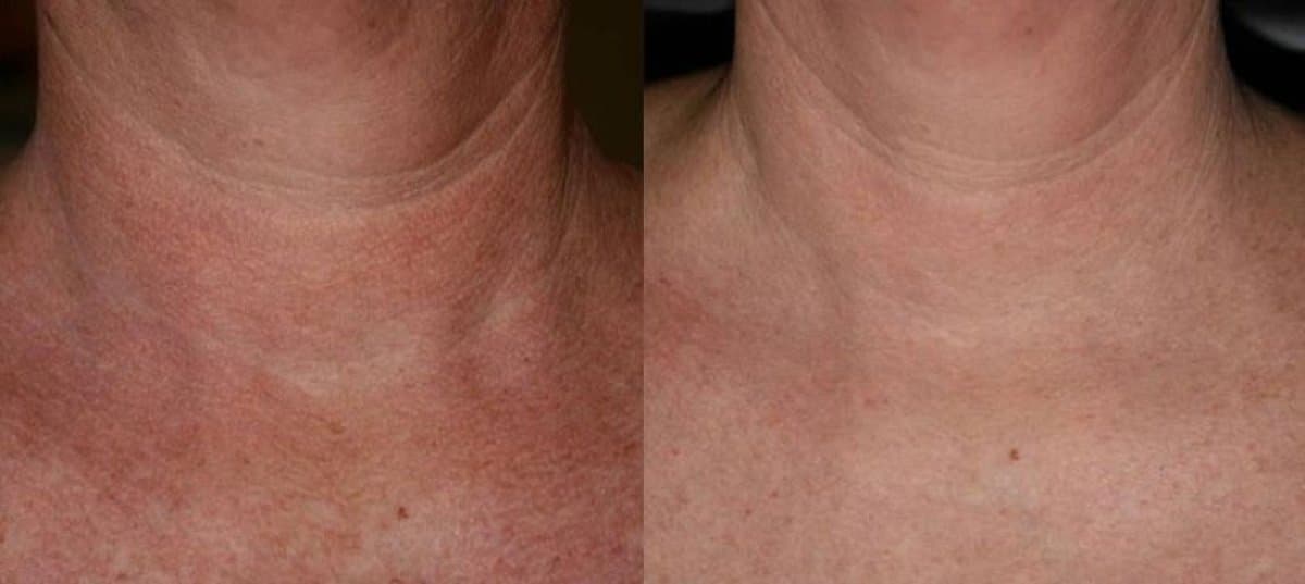 laser skin resurfacing