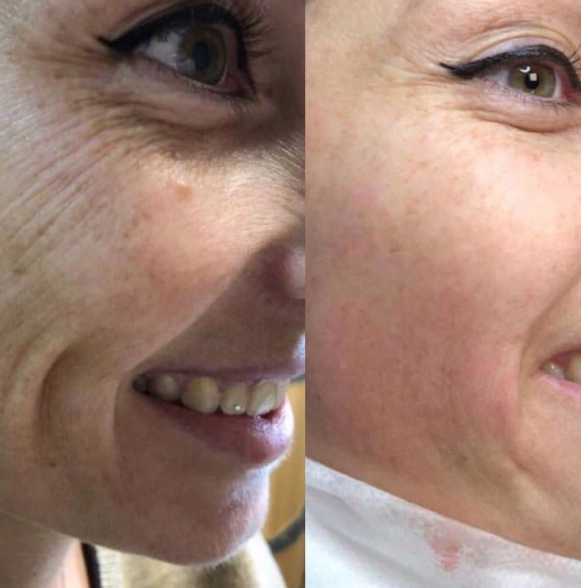 Botox injections