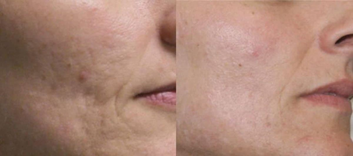 laser skin resurfacing