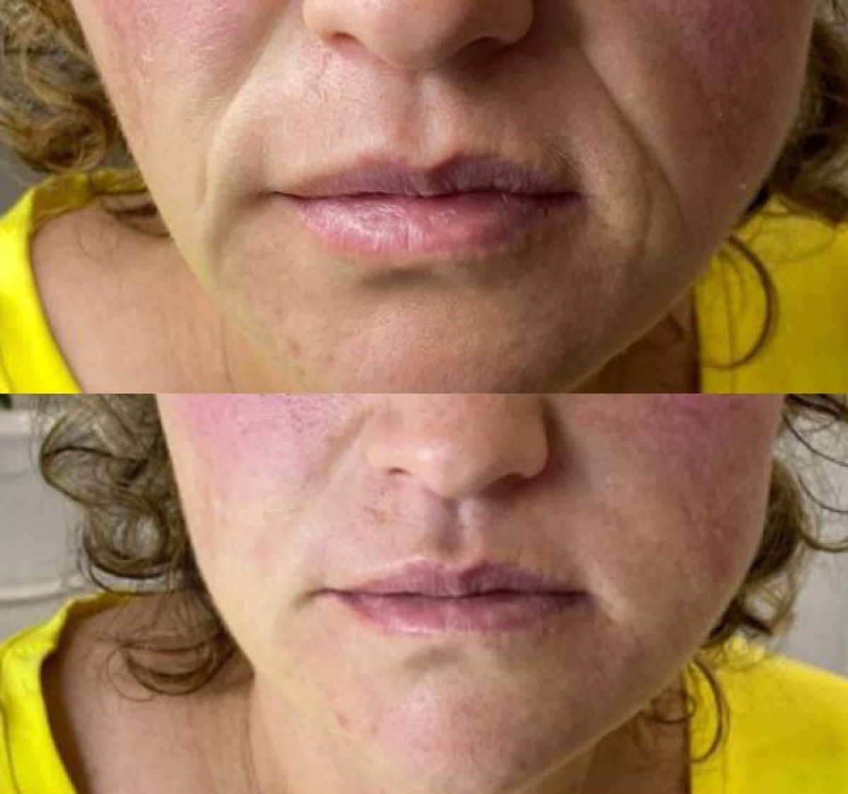 Botox injections