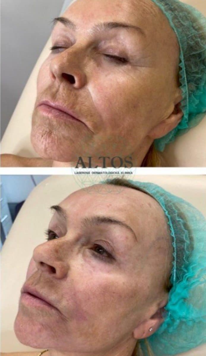 Botox injections