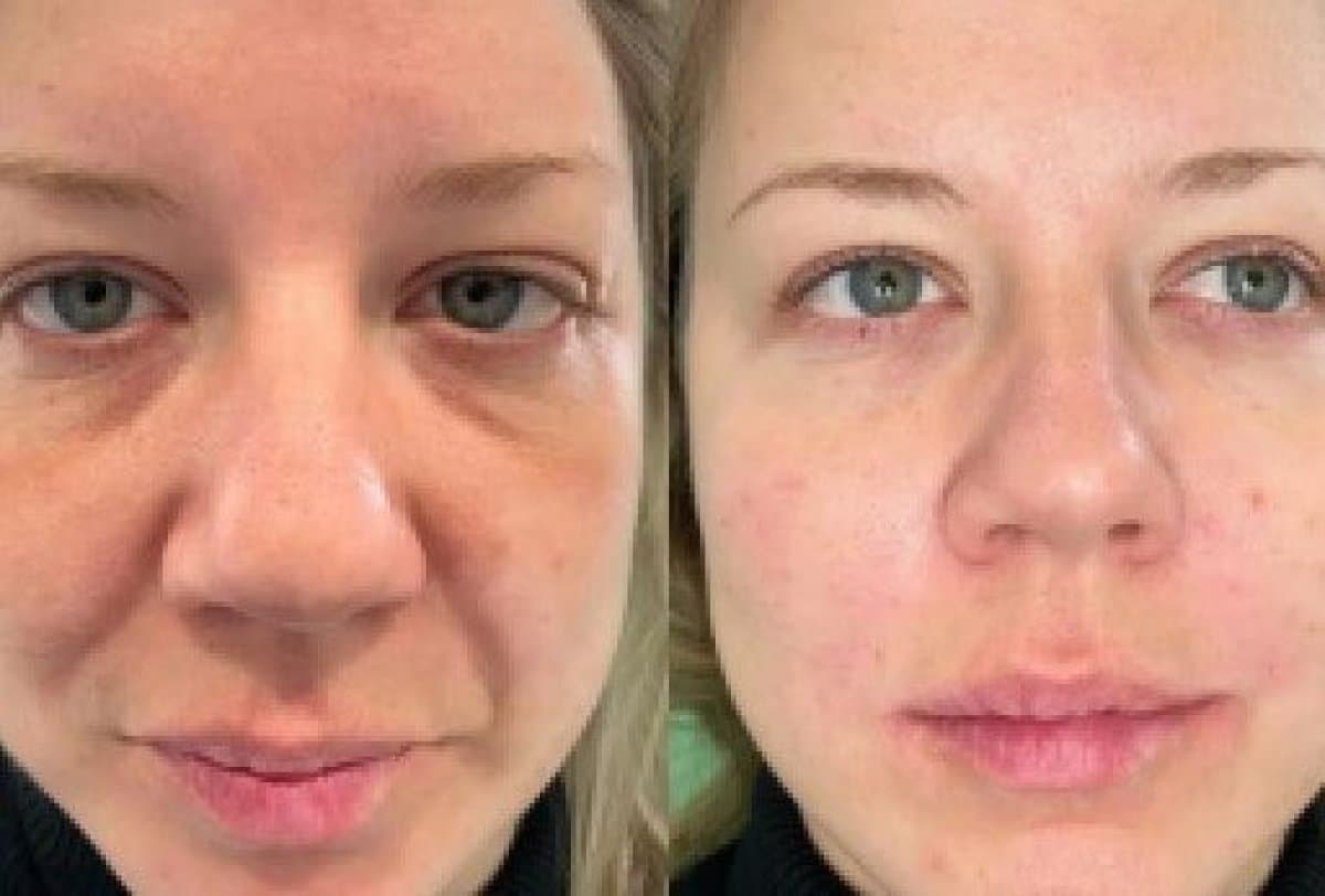 Botox injections