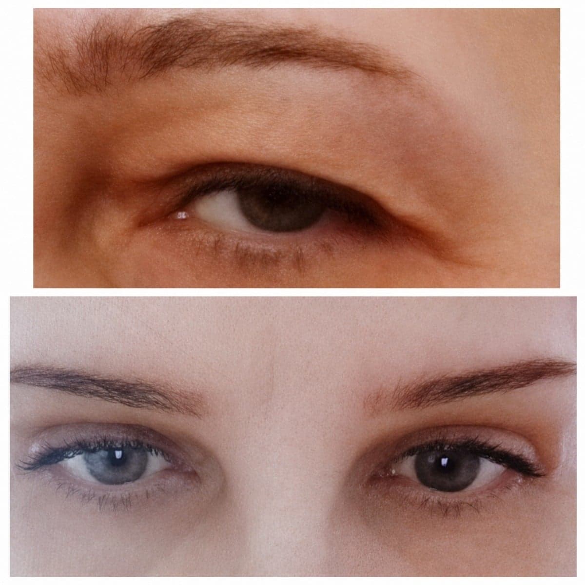 blepharoplasty