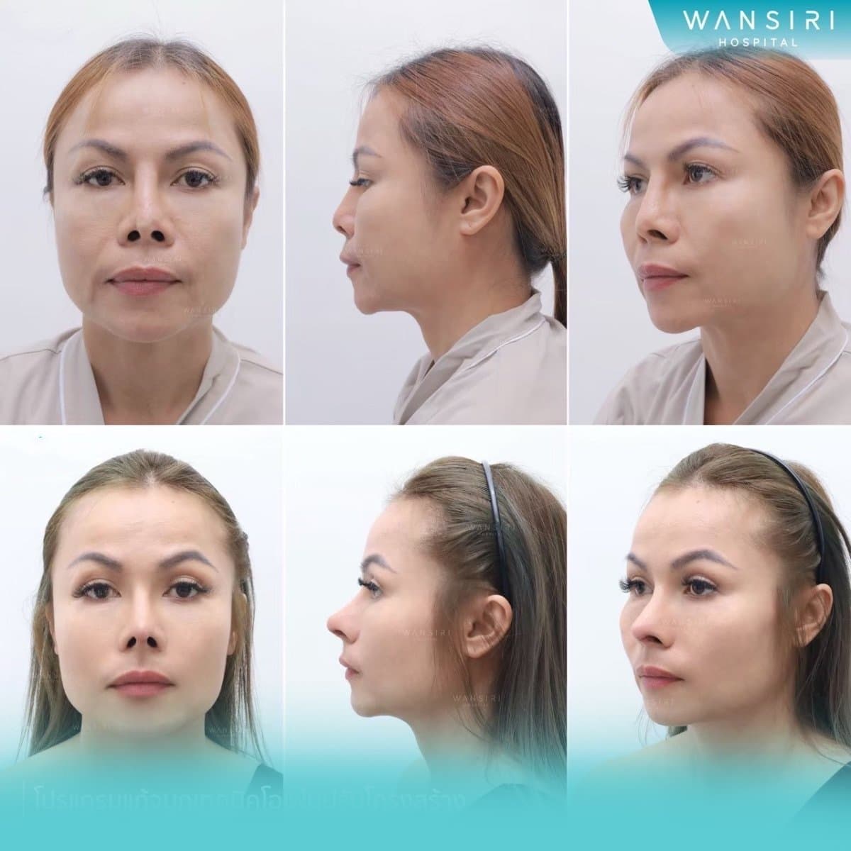 revision rhinoplasty