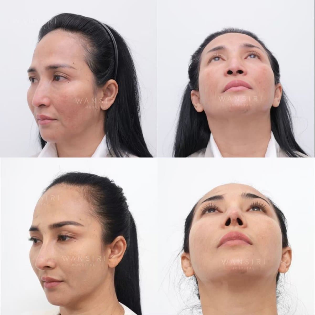 revision rhinoplasty