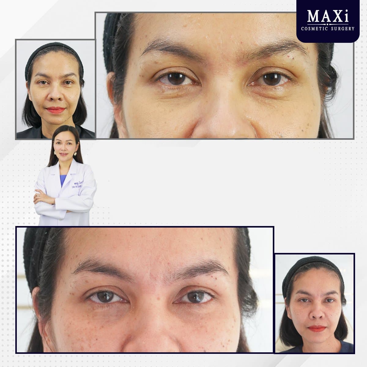 hyaluronic acid threads lifting