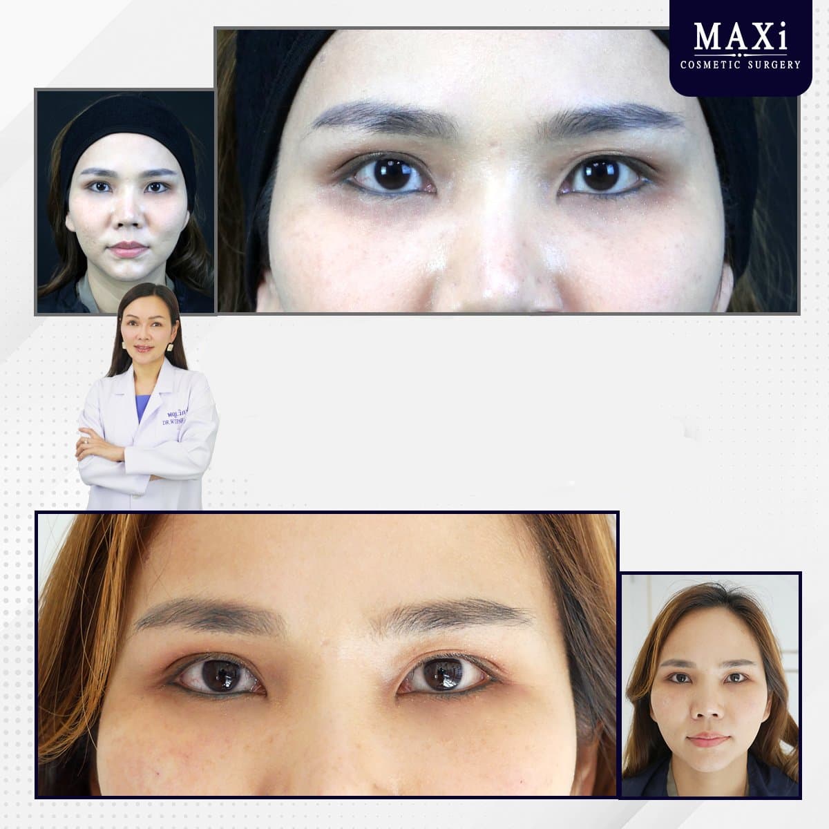 hyaluronic acid threads lifting
