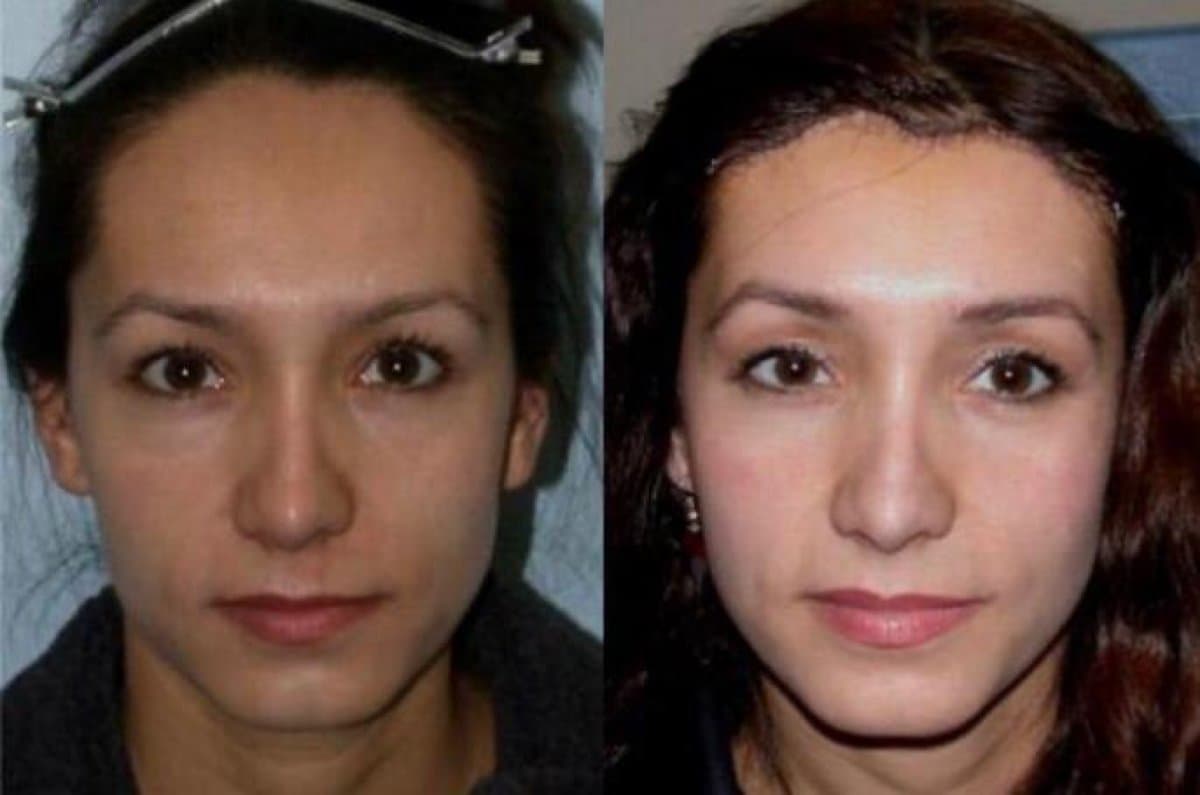 blepharoplasty