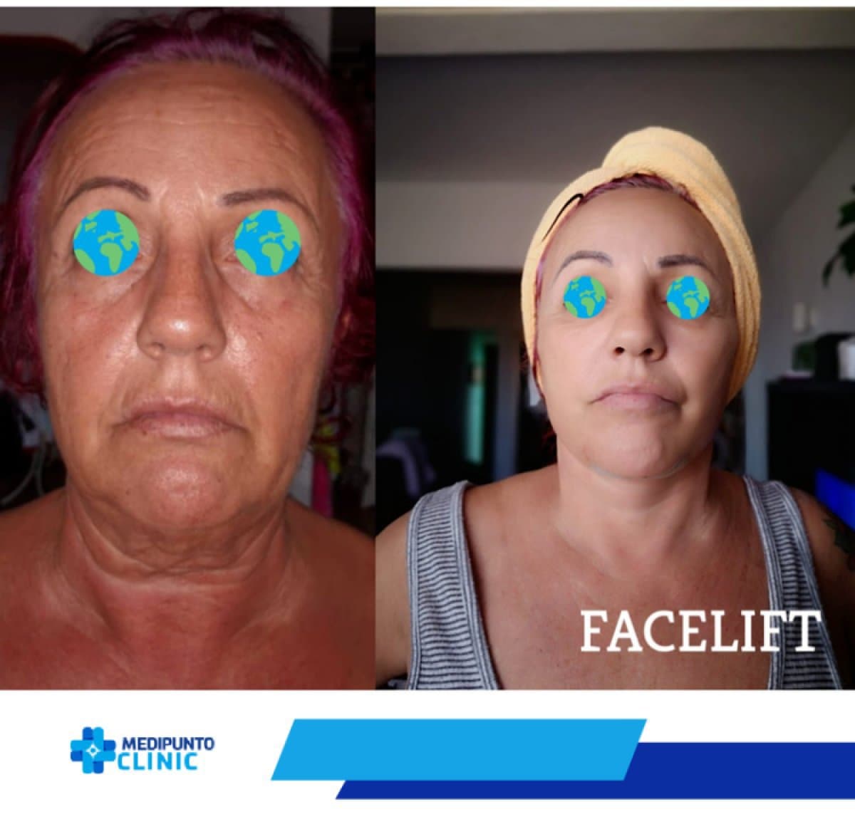 facelift