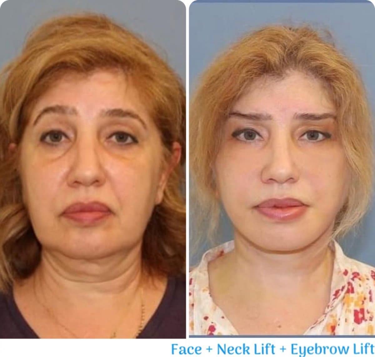 face, neck, and eyebrow lift