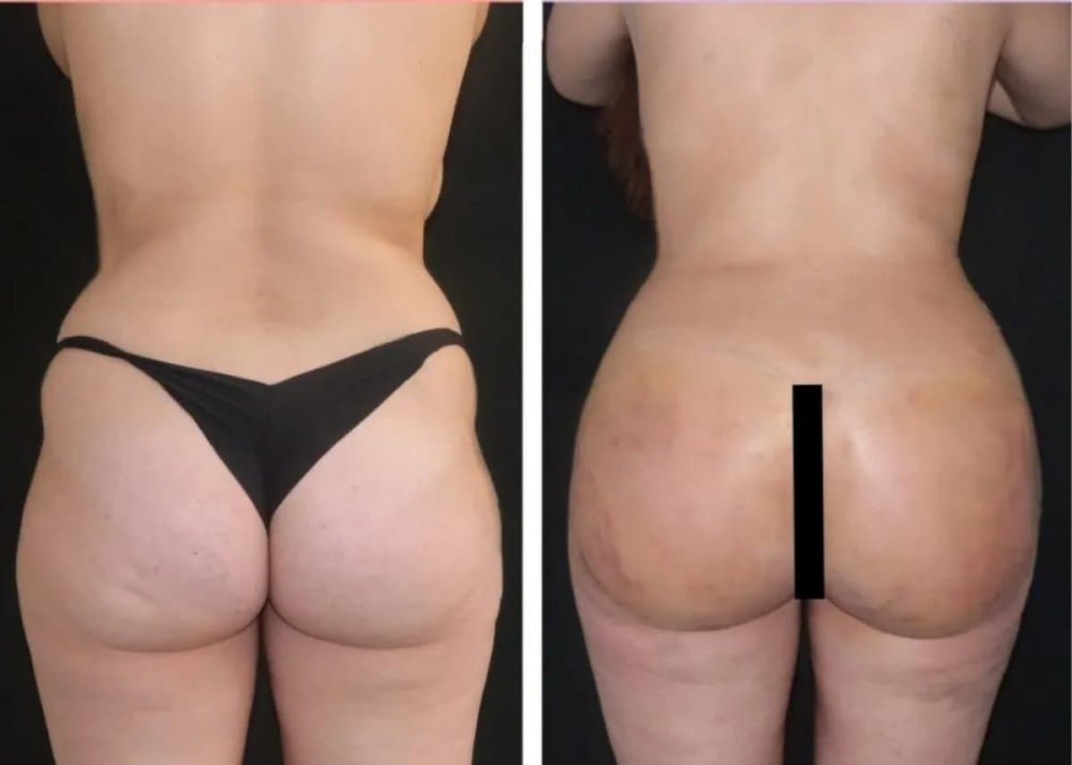 butt implants